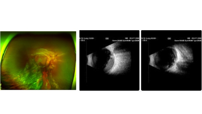 B超影像学特征 探查见右眼玻璃体腔内大量致密点状回声,提示严重积血,视网膜前广泛增殖膜形成、牵拉局部视网膜隆起。最终诊断是什么?