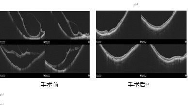 二合一,PPV+ILM-peeling for DDME,术后第二天效果如何?
