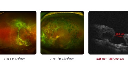 60 岁女性,双眼 PDR 22 个月内 5 次住院手术 右眼已无光感,左眼仅存 微弱视力 左眼已经过 3 次玻切手术 巨大黄斑裂孔合并血管弓处视网膜裂孔 下一步怎么办?